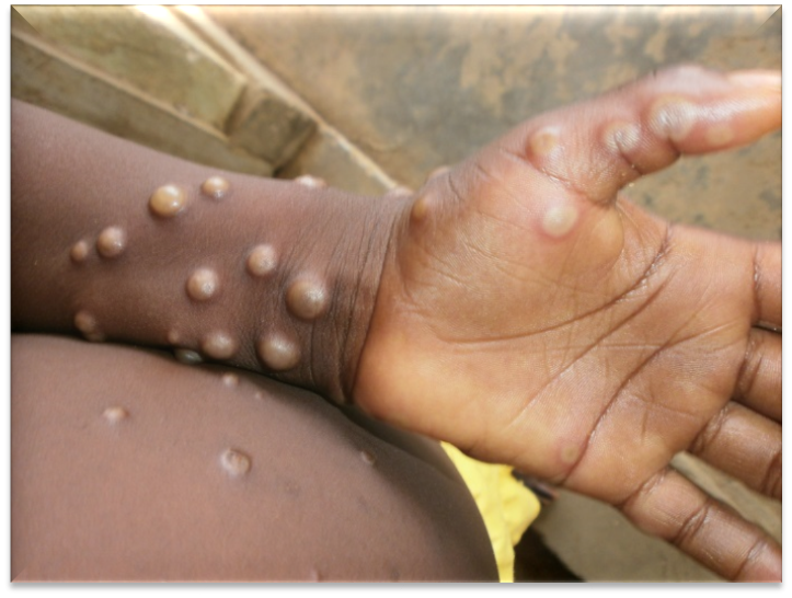 Jeune garçon présentant la maladie Mpox 